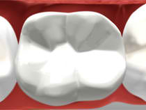 Tooth-colored composite restorations - Chilliwack
