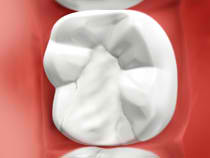 Amalgam-free Dental filling