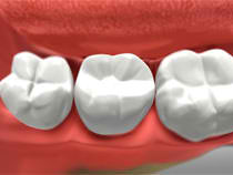 Dental Crowns - Chilliwack