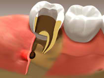 Root Canal Therapy - Chilliwack