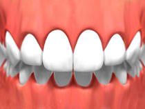 Tooth Whitening - Chilliwack